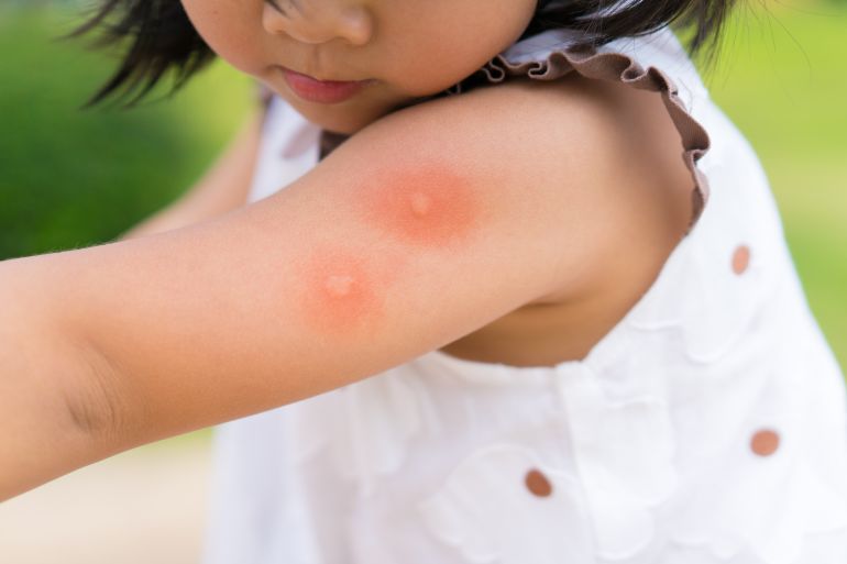 Little girl has allergies with mosquitoes bite and itching her arm.Mosquito blood breeding on kids.Repellent, Dengue virus, Yellow fever, West nile, Malaria, Diseases Spread by Mosquitoes concept.